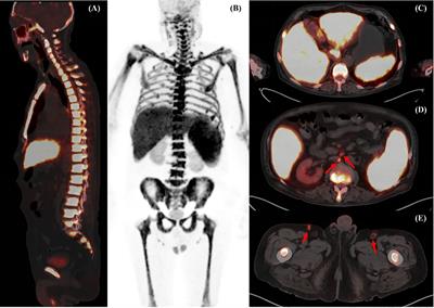 Case report: 18F-FDG PET/CT skeletal superscan-like in an adult patient with acute lymphoblastic leukemia